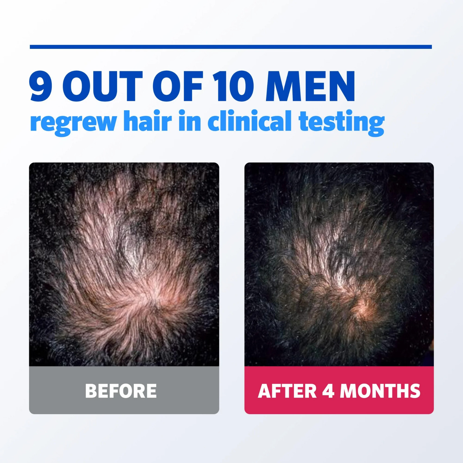 ✳️ Kirkland Minoxidil 5% Extra Strength 6 month Supply Mens Hair Treatment ✳️