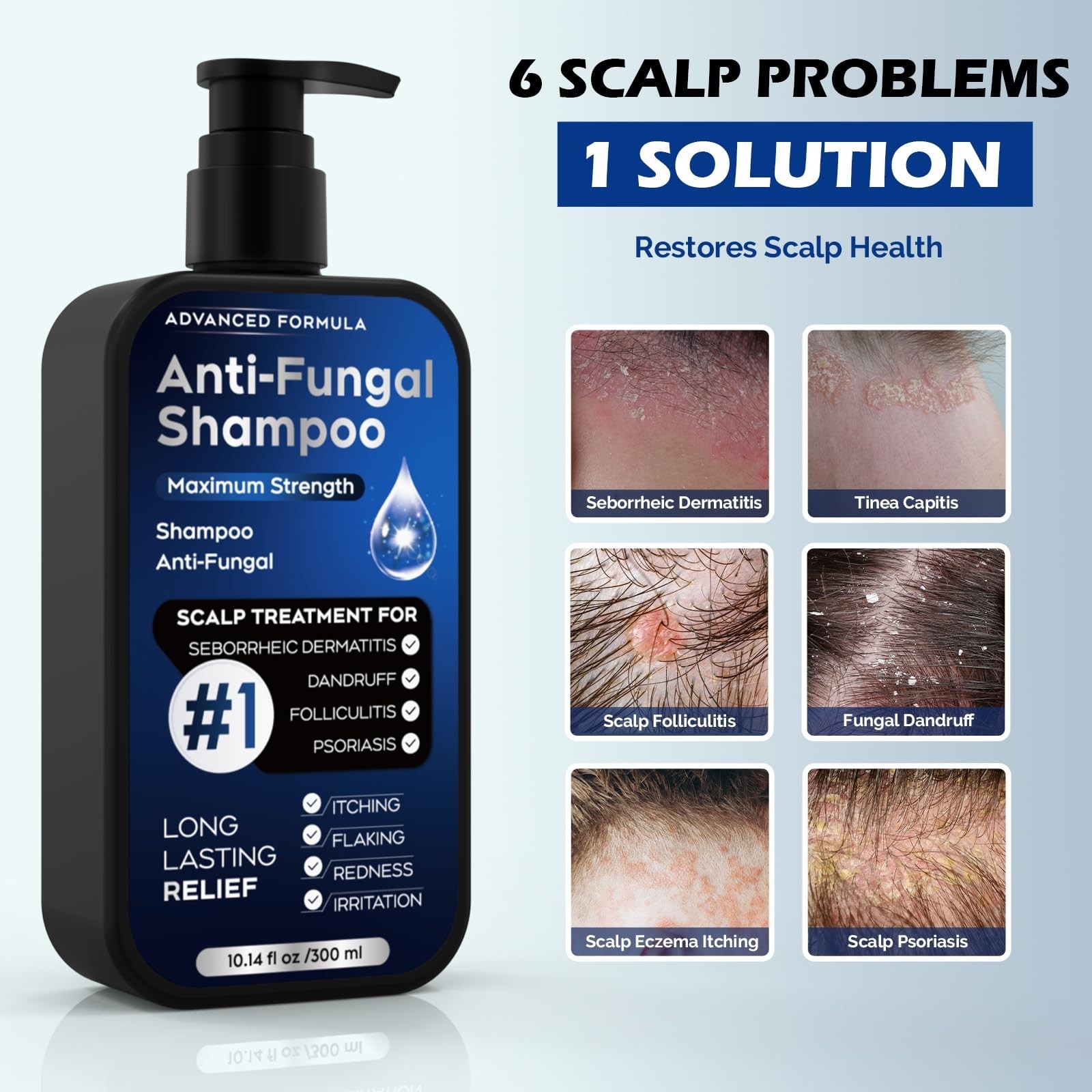 Antifungal Shampoo for Psoriasis, Seborrheic Dermatitis & Dandruff Relief, 10.1