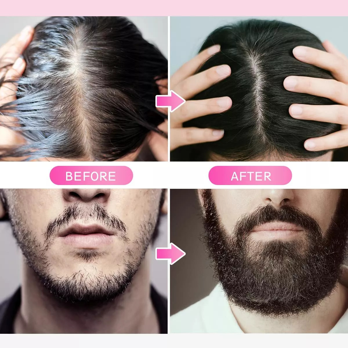 Derma Roller for Hair Loss Beard Growth 0.5-2.0mm Microneedle Dermaroller US