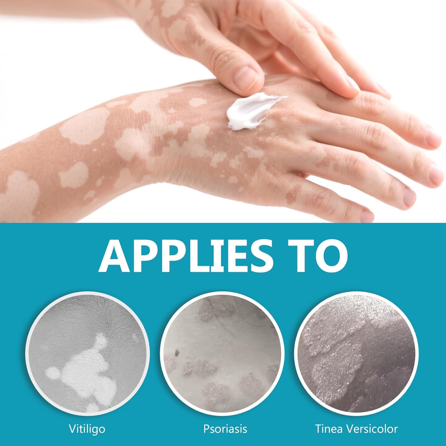 Natural Vitiligo Cream, Improves White Spots & Skin Pigmentation