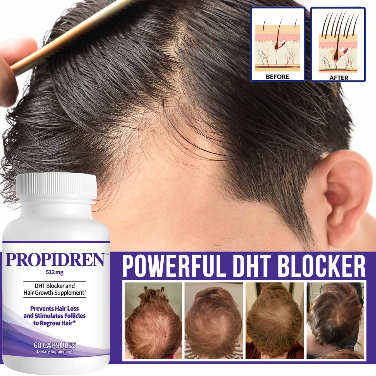 Propidren by HairGenics – DHT Blocker with Saw Palmetto To Prevent Hair Loss
