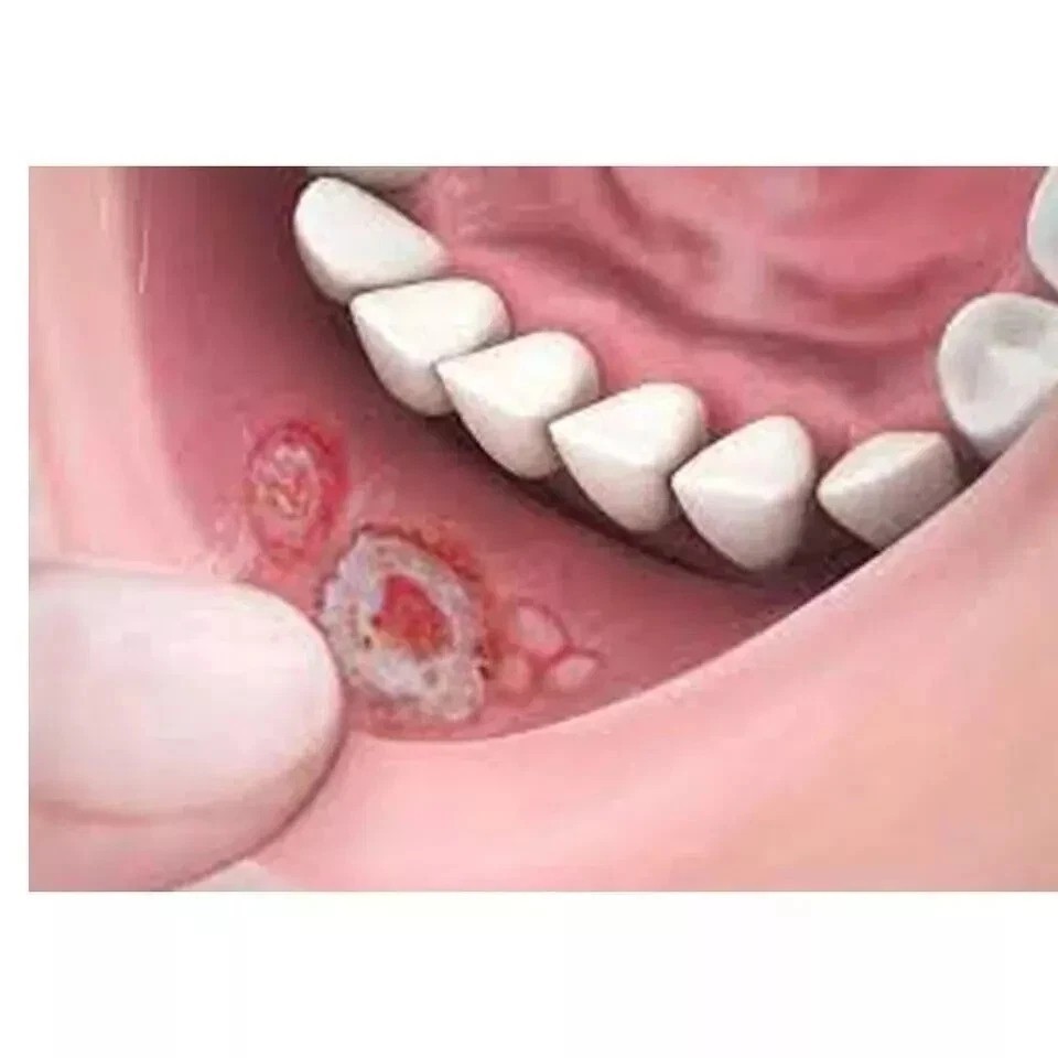 CANDID MOUTH PAINT FOR ORAL THRUSH TREATMENT 25 ML EACH – PACK OF 2