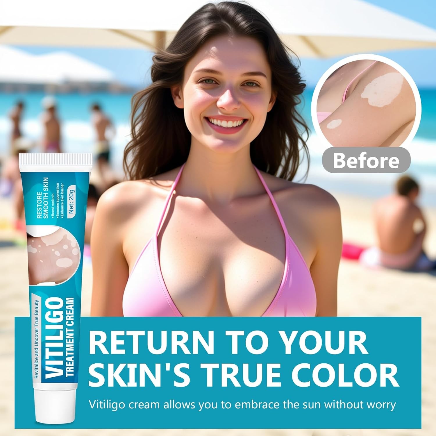 Natural Vitiligo Cream, Improves White Spots & Skin Pigmentation