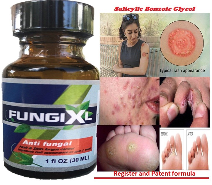 Athlete’s Foot Antifungal Support Jock Itch Ringworm Itching Anti Fungus