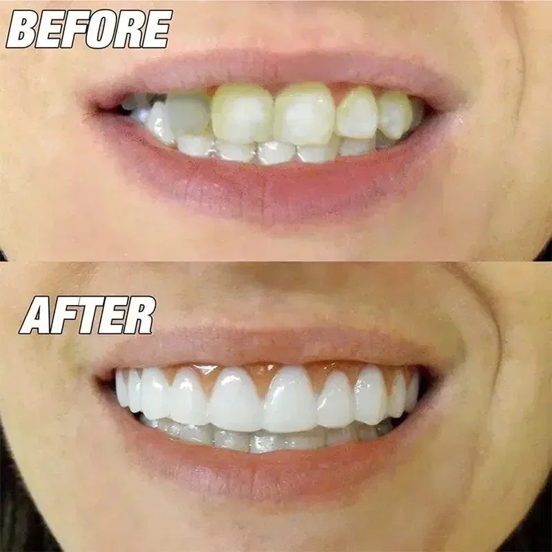 Smile Snap On False Teeth Upper Lower Dental Veneers Denture Tooth Cover Set