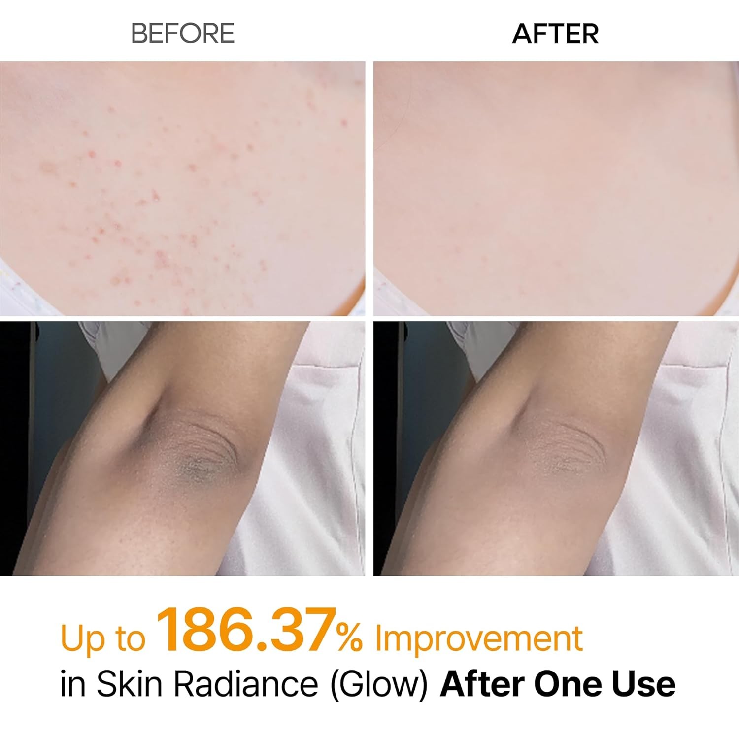 Body Keratin Care Kojic Acid Turmeric Spray w/AHA & PHA, Gentle Body Brightening