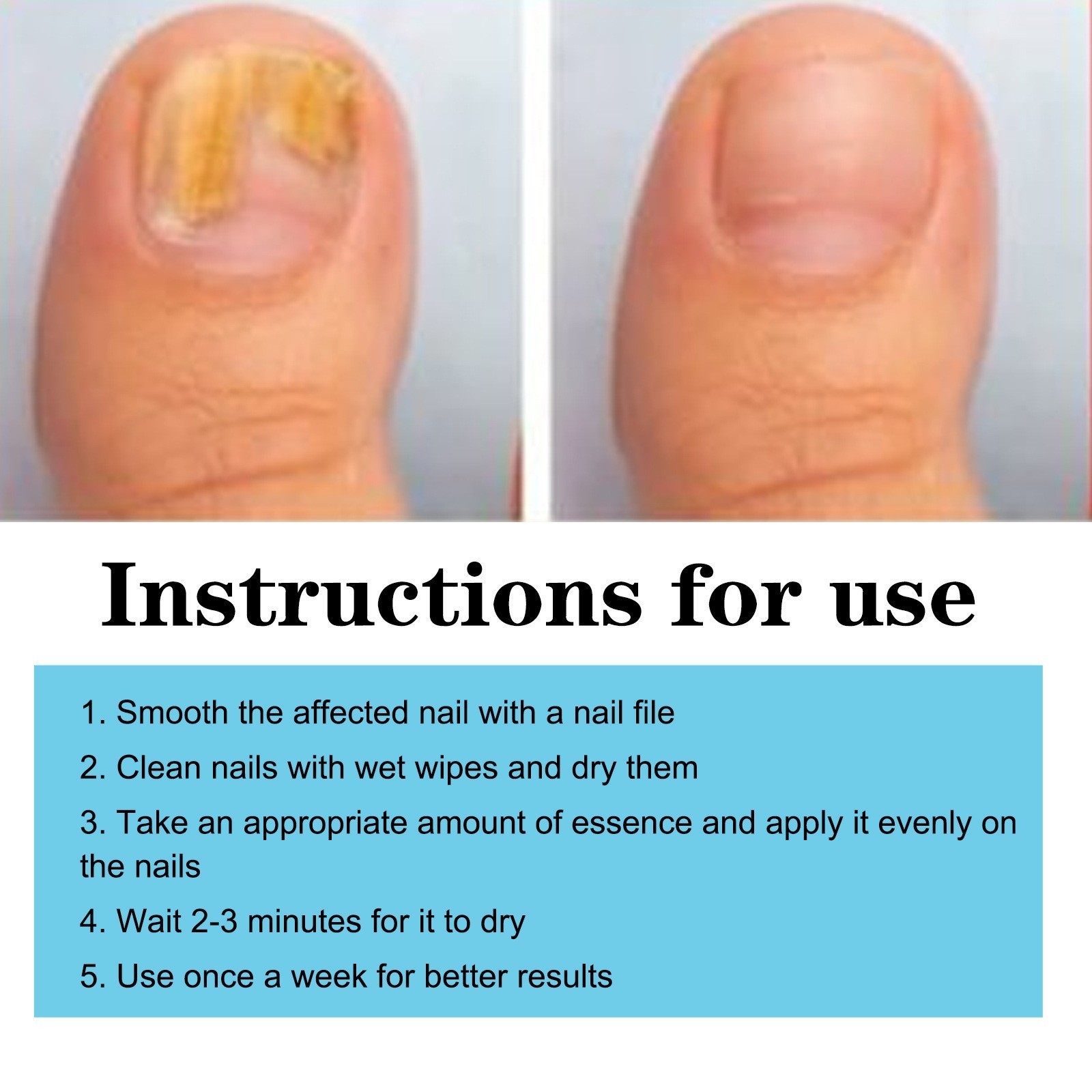 Nail Care Pen, 4/8/12Pcs Fungal Nail Pen, Nail Fungus Treatment For Toenail USA