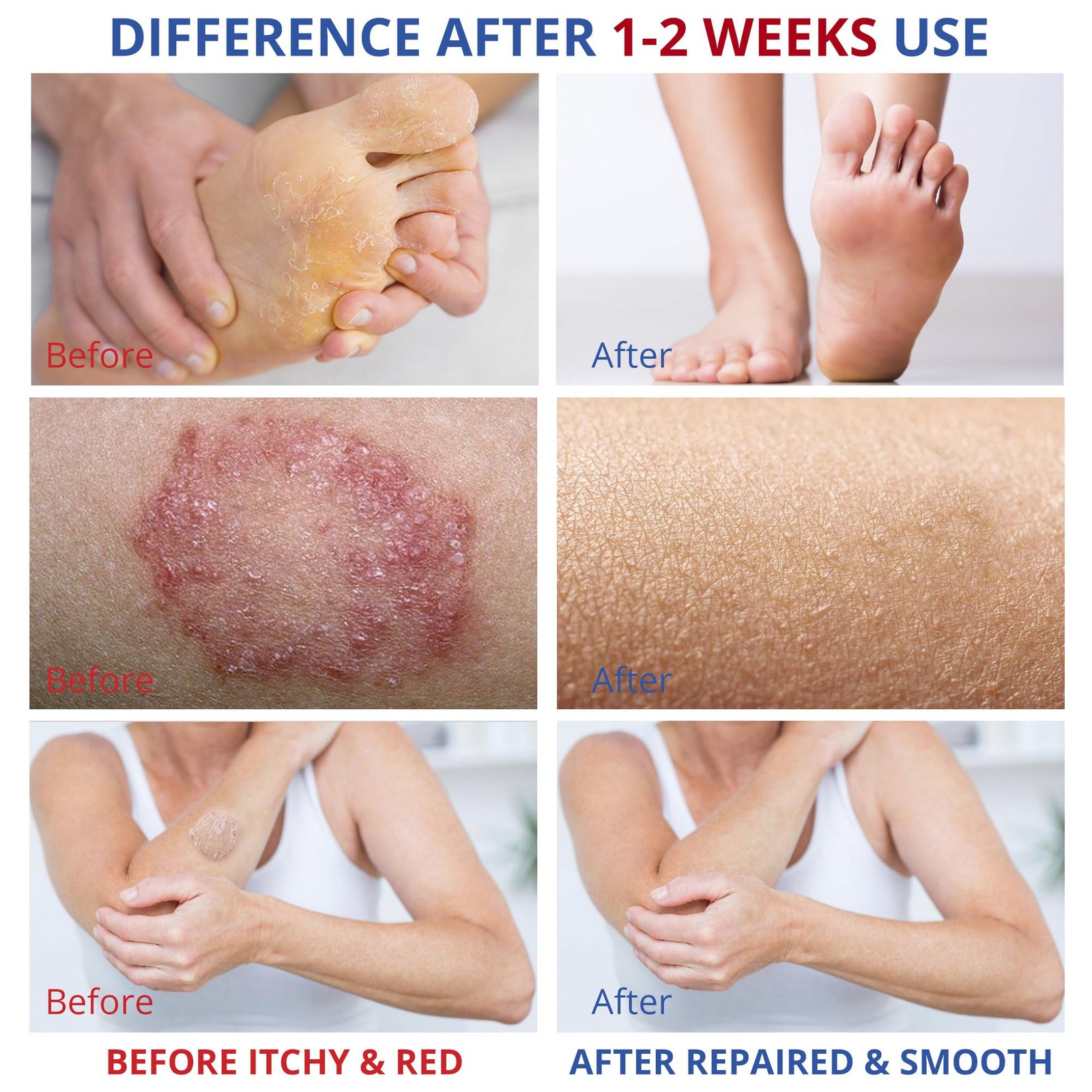 Athletes Foot Treatment-Antifungal Cream-Treatment for Jock Itch,Ringworm, Ps…