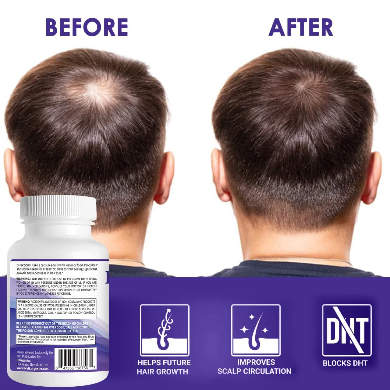 Propidren by HairGenics – DHT Blocker with Saw Palmetto To Prevent Hair Loss